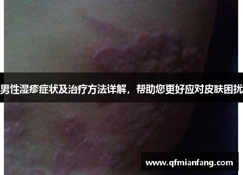 男性湿疹症状及治疗方法详解，帮助您更好应对皮肤困扰